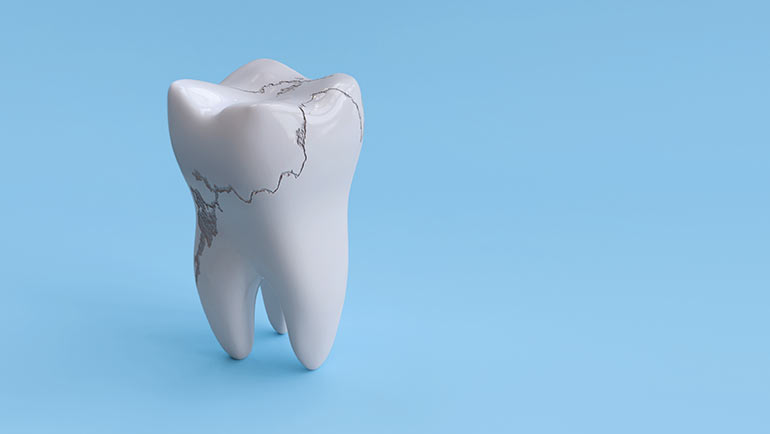Cracked Teeth in Southern Illinois at Steele Dental in Pinckneyville, Illinois