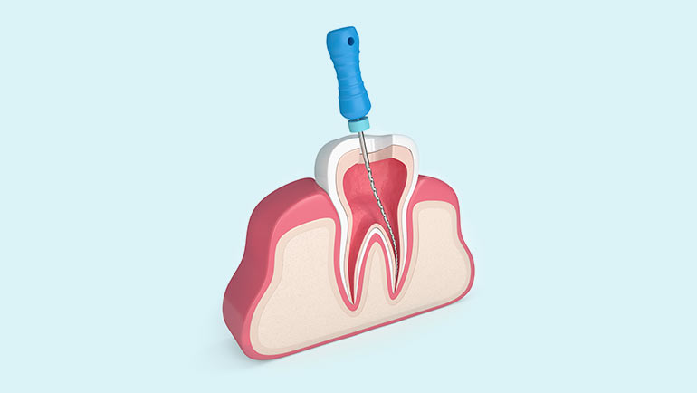 Endodontic Retreatment in Southern Illinois at Steele Dental in Pinckneyville, Illinois