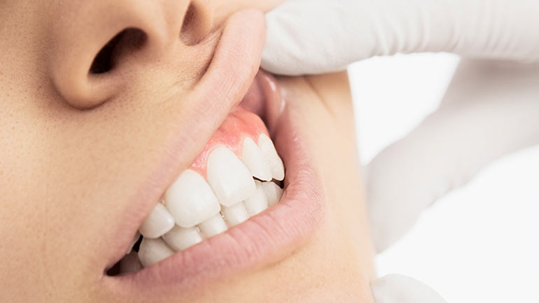 Frenectomy Treatment in Southern Illinois at Steele Dental in Pinckneyville, Illinois