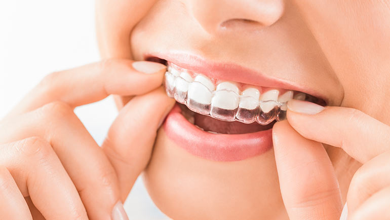 Invisalign in Southern Illinois at Steele Dental in Pinckneyville, Illinois