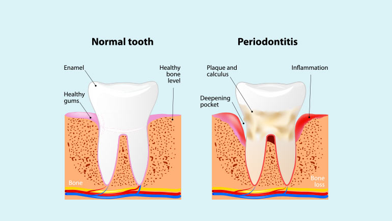 Gum Disease Treatment in Southern Illinois at Steele Dental in Pinckneyville, Illinois