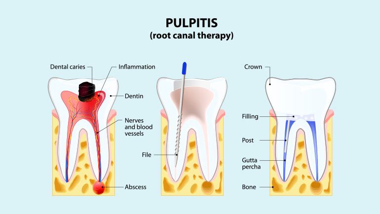 Root Canal Therapy in Southern Illinois at Steele Dental in Pinckneyville, Illinois