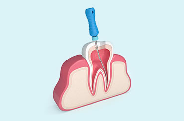 Endodontic Retreatment in Southern Illinois at Steele Dental in Pinckneyvill, Illinois
