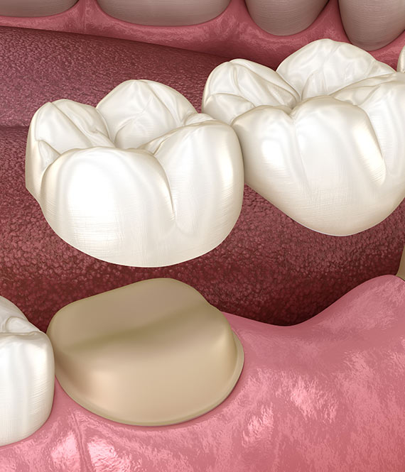 Dental Bridges