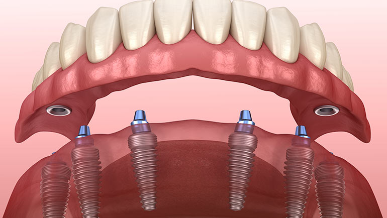 Mini Implants in Southern Illinois at Steele Dental in Pinckneyville, Illinois
