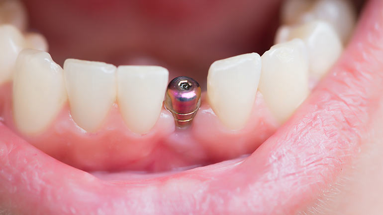 Dental Implants in Southern Illinois at Steele Dental in Pinckneyville, Illinois